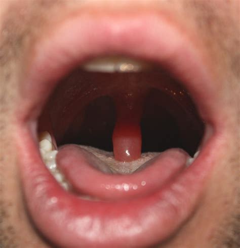 Icd 10 uvula swelling. Things To Know About Icd 10 uvula swelling. 